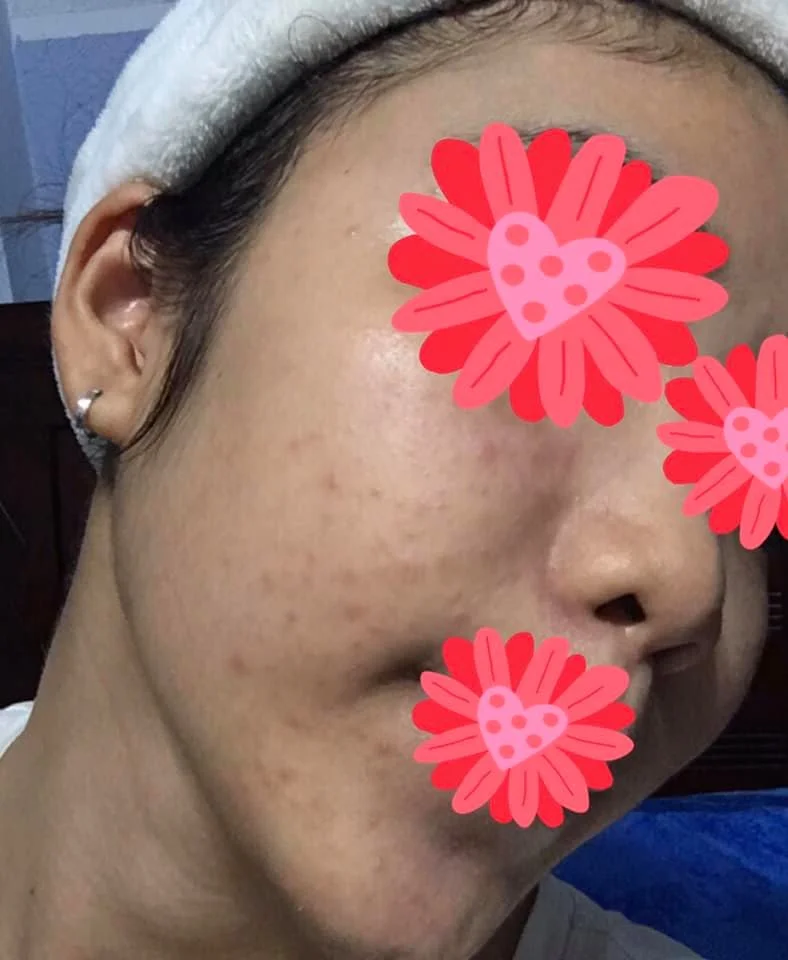 Bạn Ngọc Linh — trước