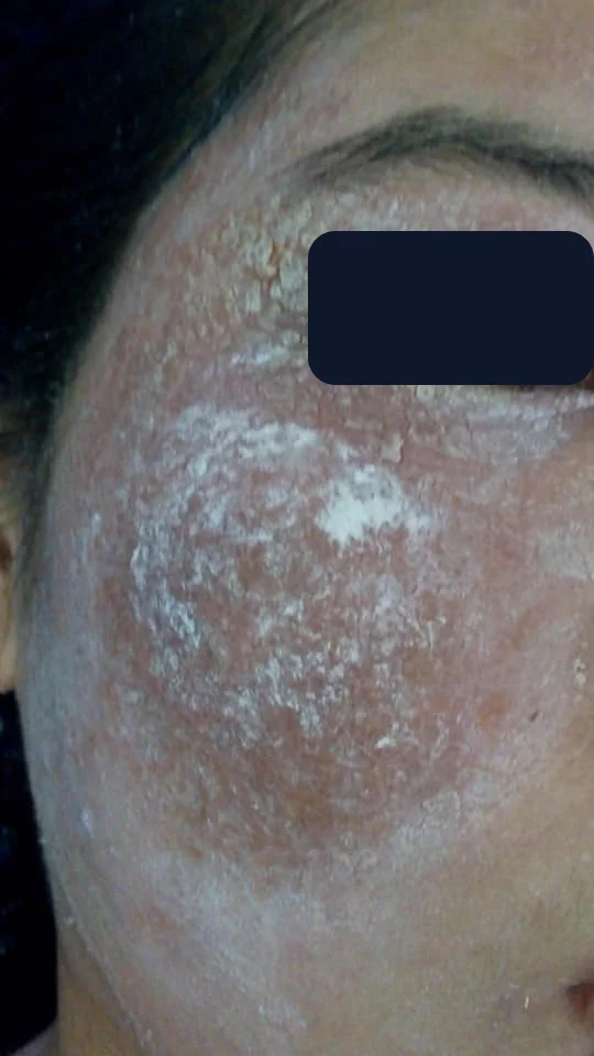 Bạn Hằng — trước
