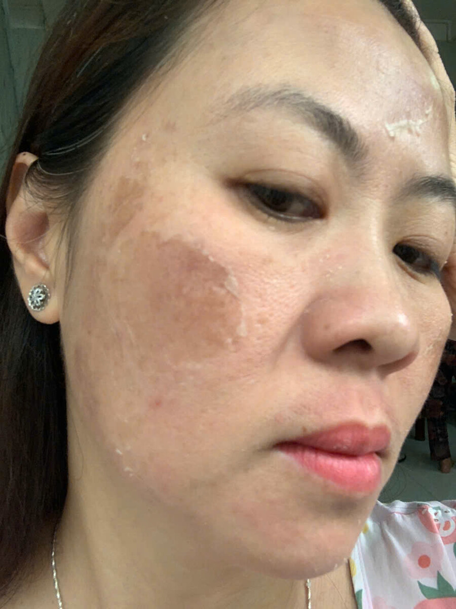 Mức bong da ngày thứ 6 — góc chụp thứ nhất.