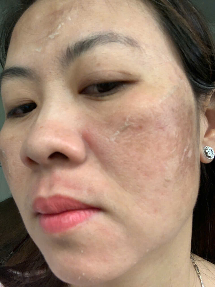 Mức bong da ngày thứ 6 — góc chụp thứ hai.